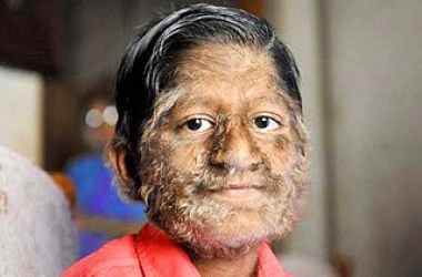 5 фактов о гирсутизме