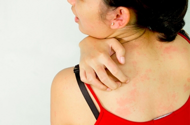 Главные признаки кожной  аллергии