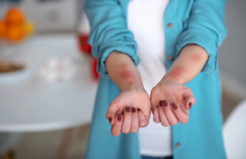 Диета при крапивнице