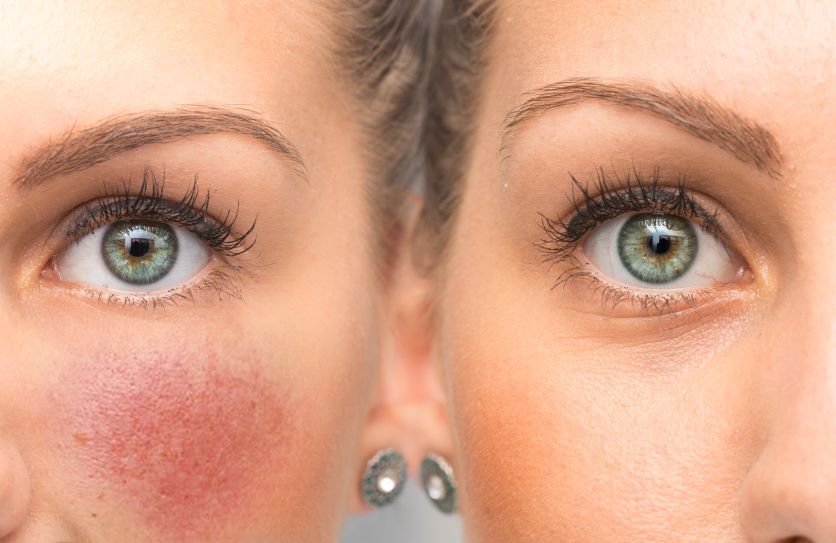 Купероз на лице