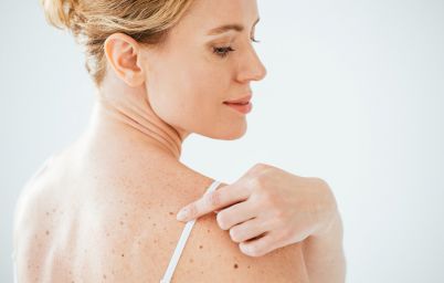 родинки,рак,онкология,как поверить родинки