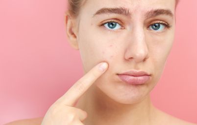 Черные точки на лице