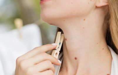 Как ухаживать за родинками