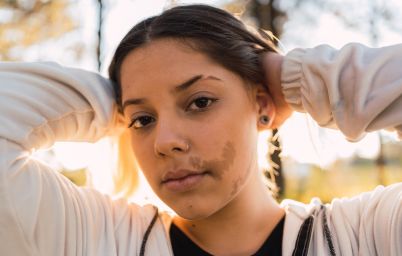 Пигментация