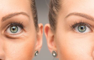 Как убрать круги под глазами