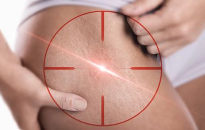 Как убрать растяжки