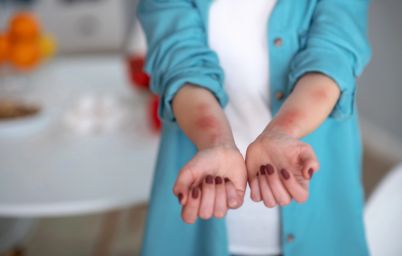 Диета при крапивнице