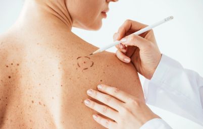 Удаление родинок