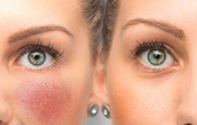 Купероз на лице