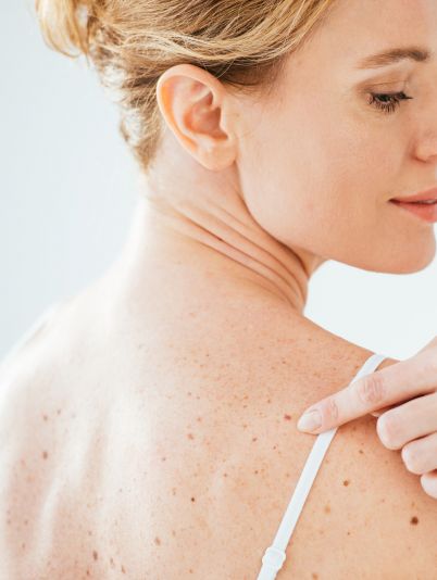 родинки,рак,онкология,как поверить родинки