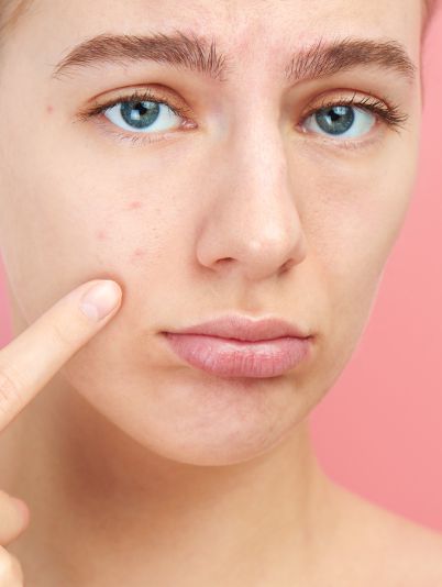 Черные точки на лице