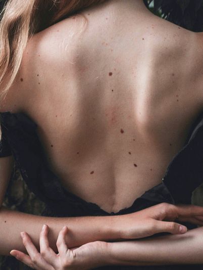 Родинки на теле