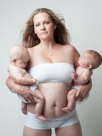 После родов: 9 вопросов пластическому хирургу