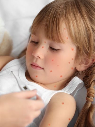 у девочки ветрянка