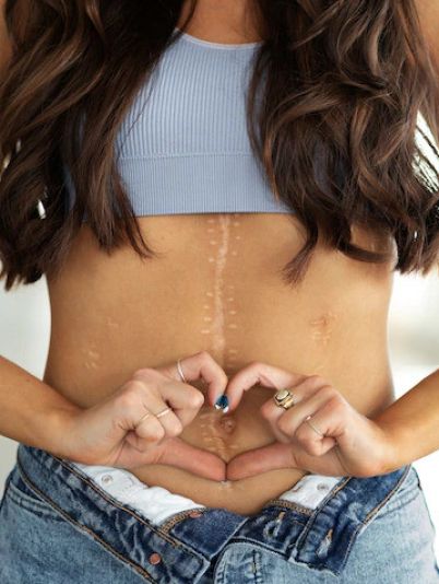 Шви після операції