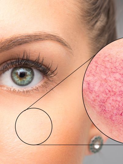 Дієта при розацеа