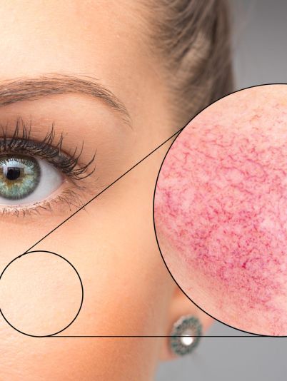 Розацеа на лице