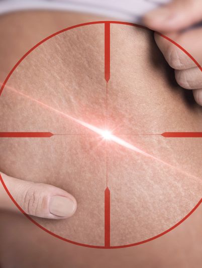 Как убрать растяжки