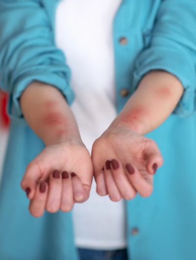 Диета при крапивнице