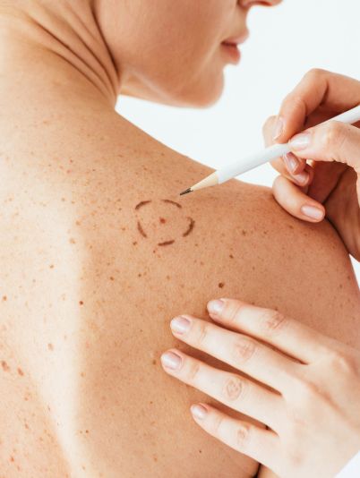 Видалення родимок