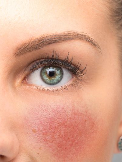 Купероз на лице