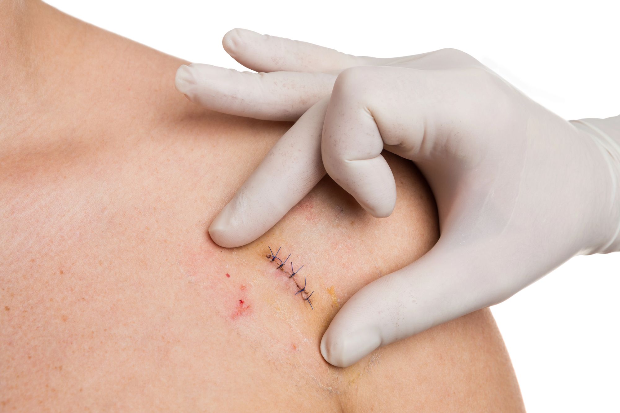 Жгут швы после операции