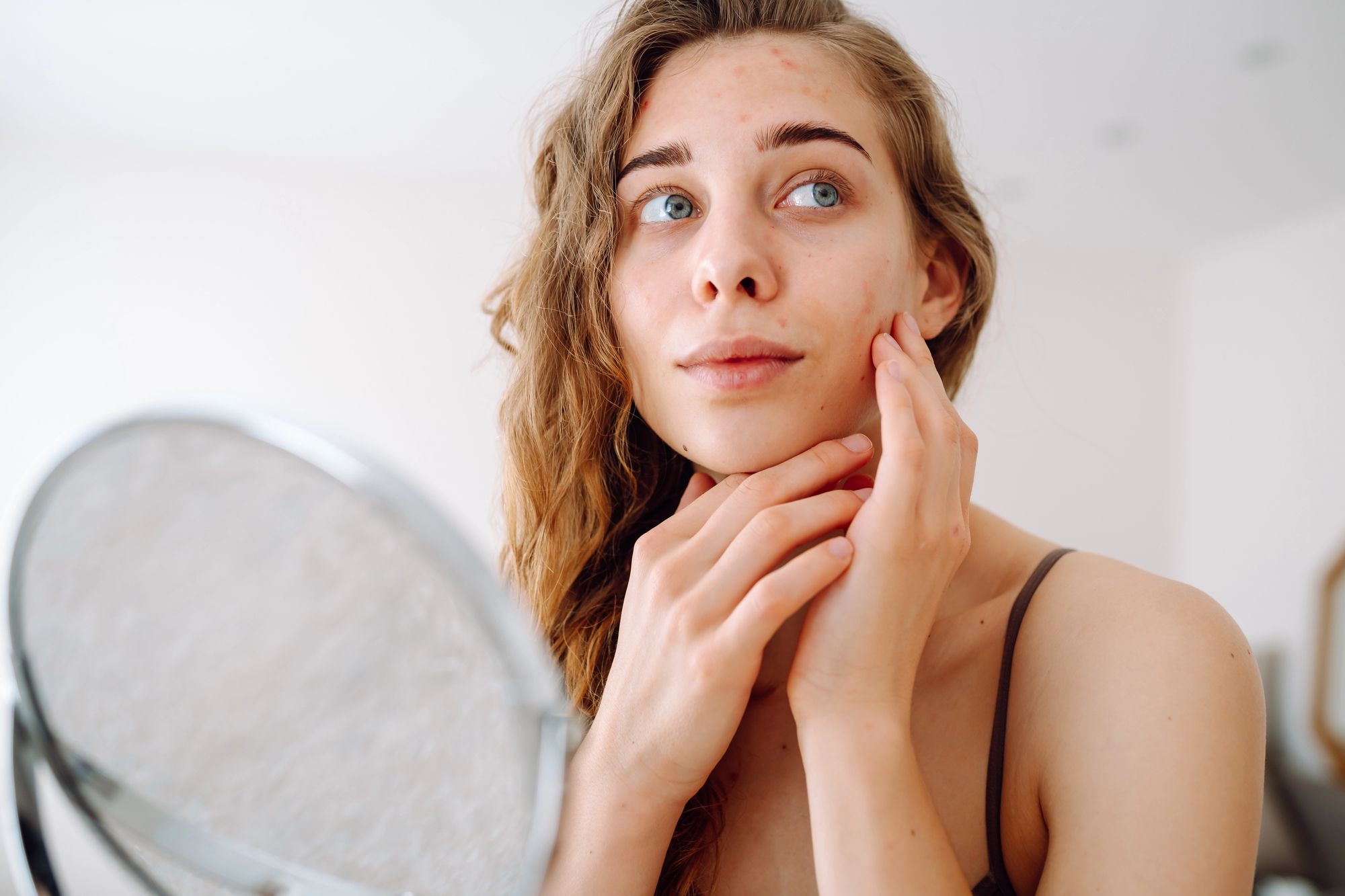 Купероз на лице